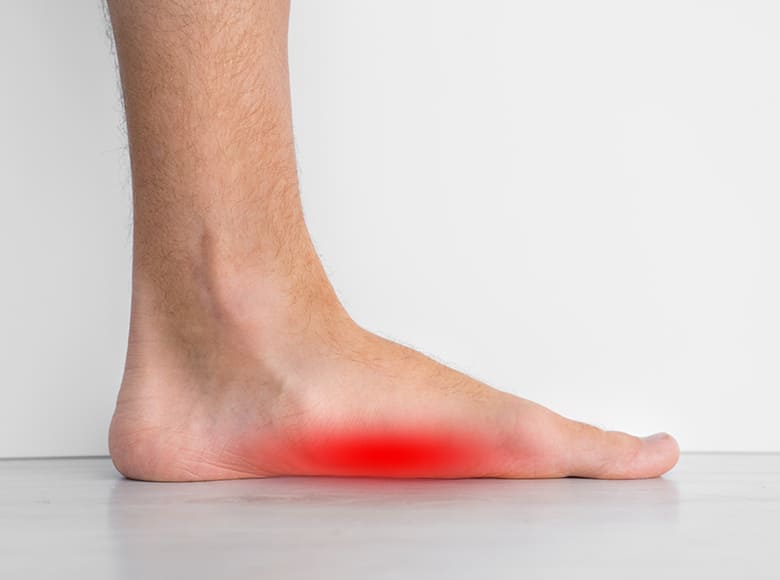 Fotografia chodidla so spadnutou klenbou