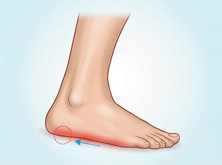 Bolesť chodidla pri zápale plantárnej fascie nazývanej plantárna fascitída