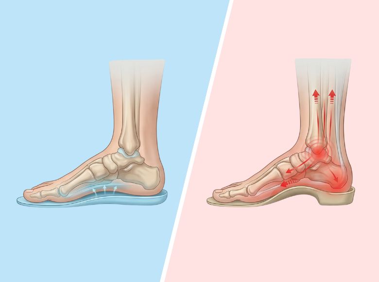 Porovnanie stielok s tvarovanou klenbovou časťou a vložiek Medicovi